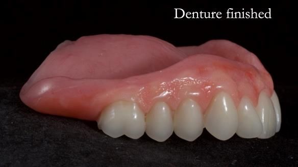 Newsletter 68 Restoring Jan’s Smile: Complete Dentures Inspired by Her Daughter’s Teeth - Post Mouth Surgery