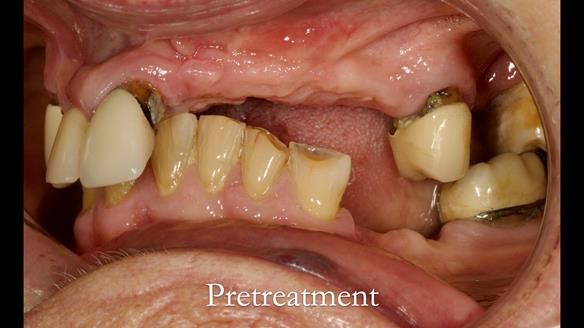 Eileen's transformation with upper and lower RPDs of Scandinavian hygienic design FULL PROTOCOL