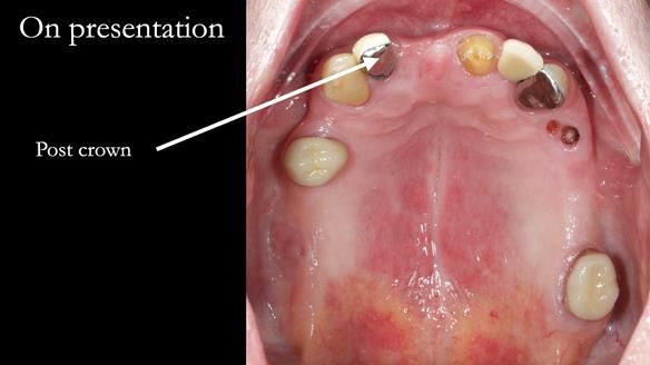 Managing Edgar “THE SCEPTIC” with an RPD/Splint FULL CASE