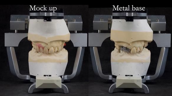 Read Newsletter 67 - Brian's COMBAT DENTURE Case Study