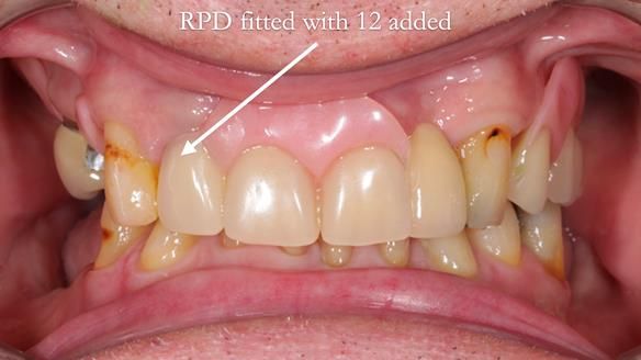 Managing Edgar “THE SCEPTIC” with an RPD/Splint FULL CASE