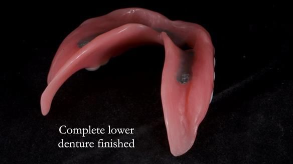 Newsletter 65 Marisa Provision of Complete Dentures on badly placed implants