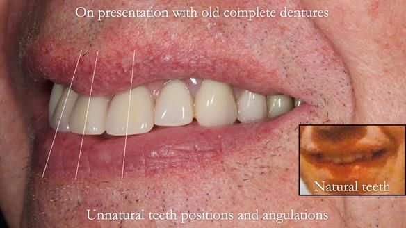 Newsletter 74: Ken’s Case Study Complete Dentures - Life Like and Age Appropriate