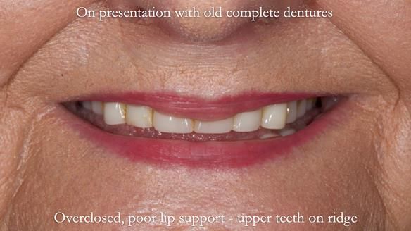 Newsletter 68 Restoring Jan’s Smile: Complete Dentures Inspired by Her Daughter’s Teeth - Post Mouth Surgery