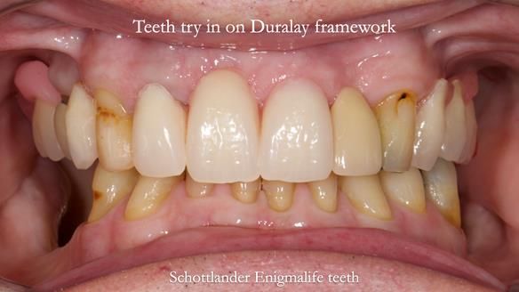 Managing Edgar “THE SCEPTIC” with an RPD/Splint FULL CASE