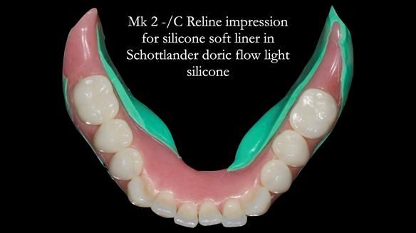 Replacing Madeline’s Complete denture FULL PROTOCOL