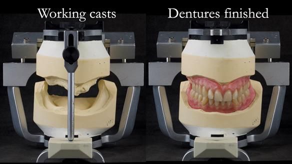 Newsletter 74: Ken’s Case Study Complete Dentures - Life Like and Age Appropriate