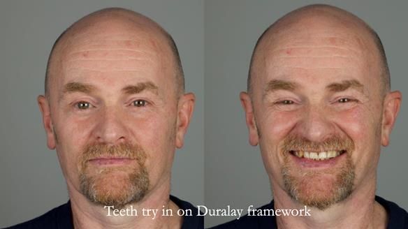 How Keith’s combat denture transformed his life – Newsletter 73