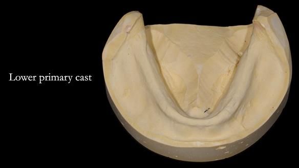 Newsletter 70 Complete Denture Treatment for Kate: A Case Study on Natural-Looking Dentures and Implant-Supported Overdentures