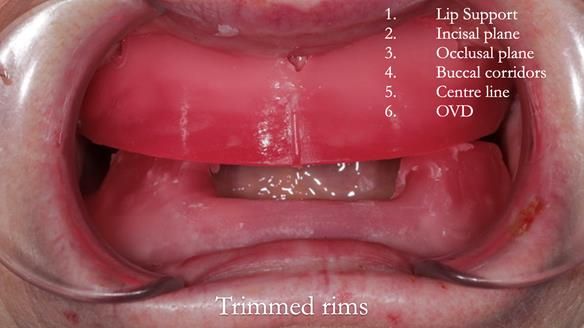 Newsletter 48 Mavis's Complete denture FULL PROTOCOL