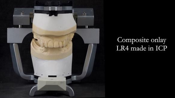 Eileen's transformation with upper and lower RPDs of Scandinavian hygienic design FULL PROTOCOL