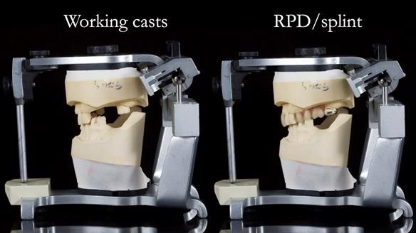 Managing Edgar “THE SCEPTIC” with an RPD/Splint FULL CASE