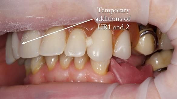 Eileen's transformation with upper and lower RPDs of Scandinavian hygienic design FULL PROTOCOL