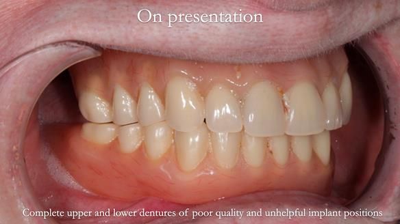 Newsletter 65 Marisa Provision of Complete Dentures on badly placed implants