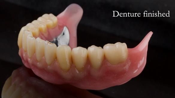 Newsletter 74: Ken’s Case Study Complete Dentures - Life Like and Age Appropriate