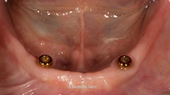 Newsletter 70 Complete Denture Treatment for Kate: A Case Study on Natural-Looking Dentures and Implant-Supported Overdentures