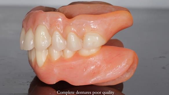 Newsletter 65 Marisa Provision of Complete Dentures on badly placed implants