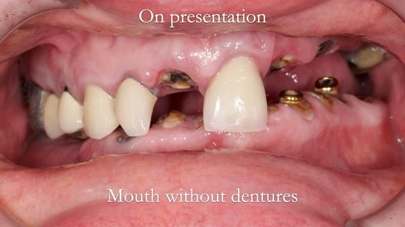 Newsletter 44 - extreme removable prosthodontics – engineering a super-strong and ultra-thin over denture