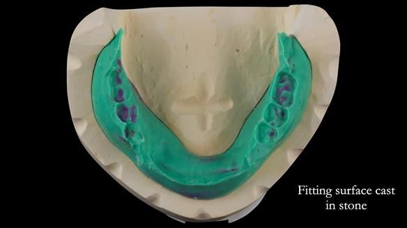 Replacing Madeline’s Complete denture FULL PROTOCOL