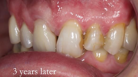 Read Newsletter 67 - Brian's COMBAT DENTURE Case Study