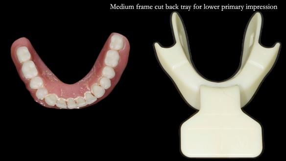 Newsletter 74: Ken’s Case Study Complete Dentures - Life Like and Age Appropriate