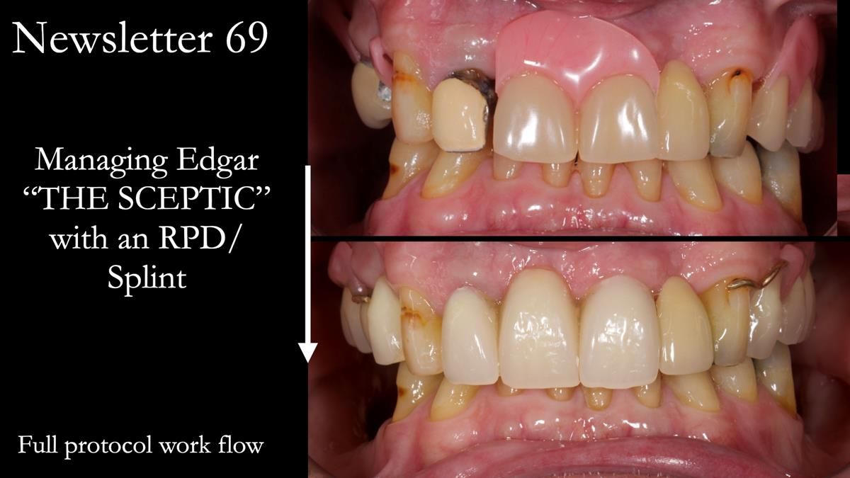 Managing Edgar “THE SCEPTIC” with an RPD/Splint FULL CASE