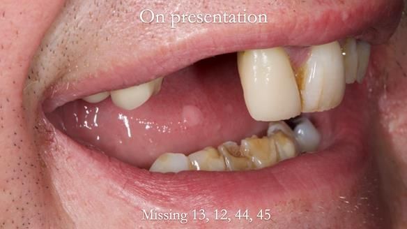 Read Newsletter 67 - Brian's COMBAT DENTURE Case Study