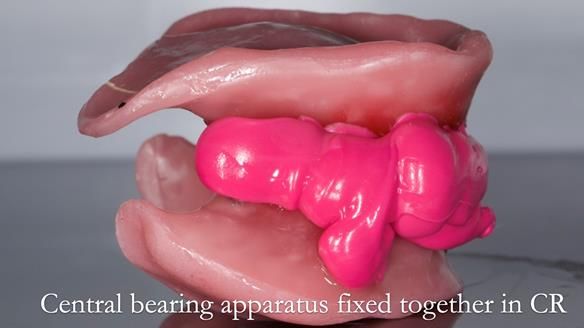 Replacing Madeline’s Complete denture FULL PROTOCOL