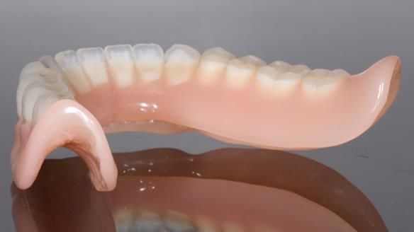 Newsletter 70 Complete Denture Treatment for Kate: A Case Study on Natural-Looking Dentures and Implant-Supported Overdentures