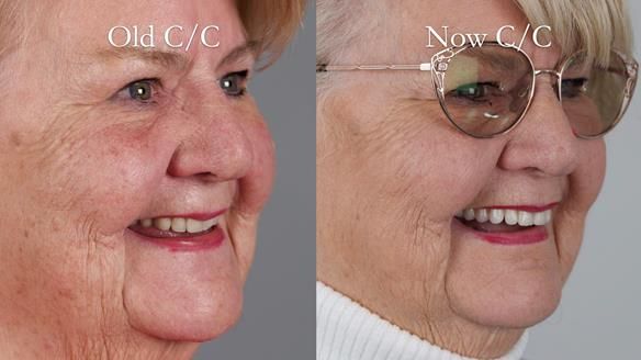 Replacing Madeline’s Complete denture FULL PROTOCOL