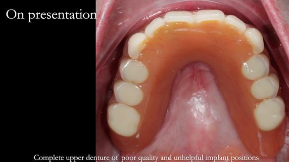 Newsletter 65 Marisa Provision of Complete Dentures on badly placed implants