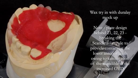 Read Newsletter 67 - Brian's COMBAT DENTURE Case Study