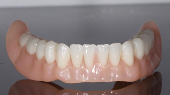 Newsletter 70 Complete Denture Treatment for Kate: A Case Study on Natural-Looking Dentures and Implant-Supported Overdentures