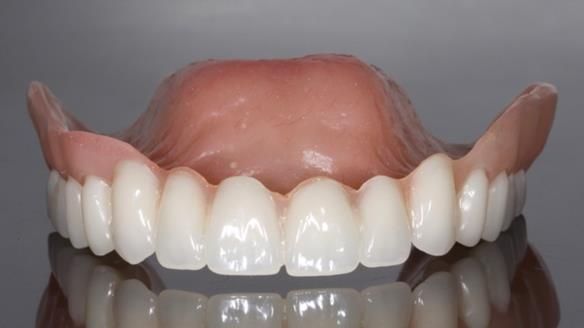 Newsletter 70 Complete Denture Treatment for Kate: A Case Study on Natural-Looking Dentures and Implant-Supported Overdentures