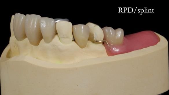 Managing Edgar “THE SCEPTIC” with an RPD/Splint FULL CASE