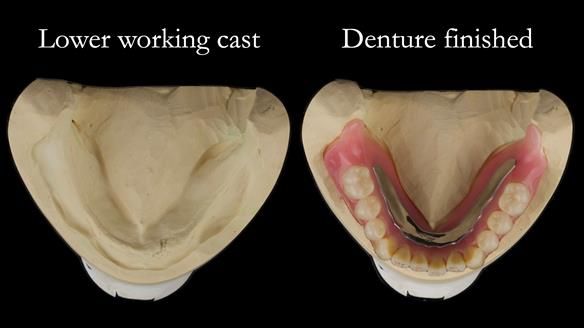 Newsletter 74: Ken’s Case Study Complete Dentures - Life Like and Age Appropriate