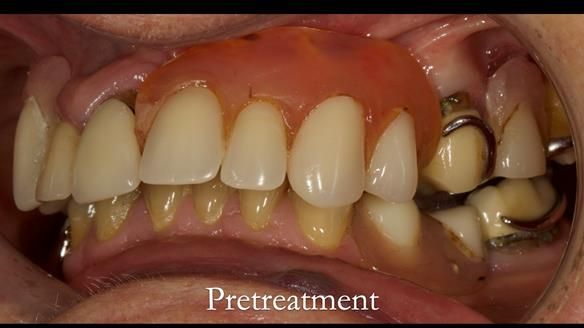 Eileen's transformation with upper and lower RPDs of Scandinavian hygienic design FULL PROTOCOL