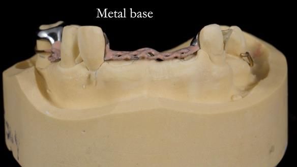 Managing Edgar “THE SCEPTIC” with an RPD/Splint FULL CASE