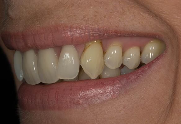 Figure 84 Fitted cobalt chromium based partial dentures with Schottlander Enigmalife teeth