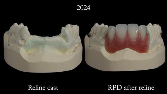 Newsletter 66 Long term case study. Life changing metal based RPD made for Anna