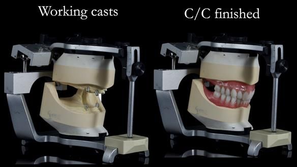 Newsletter 65 Marisa Provision of Complete Dentures on badly placed implants