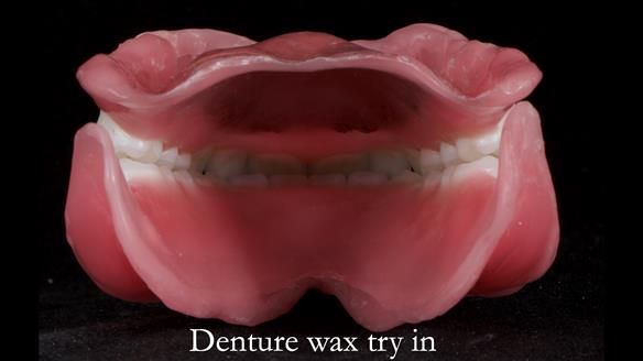 Newsletter 65 Marisa Provision of Complete Dentures on badly placed implants