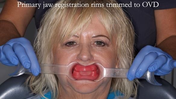 Newsletter 68 Restoring Jan’s Smile: Complete Dentures Inspired by Her Daughter’s Teeth - Post Mouth Surgery