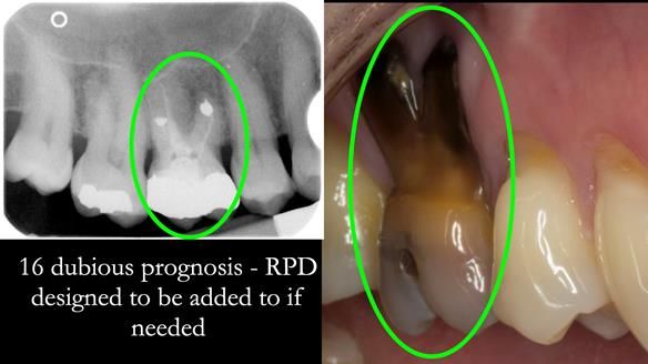 Newsletter 66 Long term case study. Life changing metal based RPD made for Anna