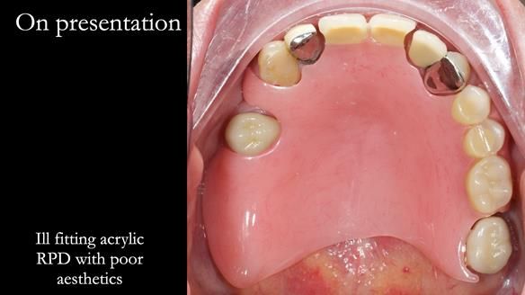 Managing Edgar “THE SCEPTIC” with an RPD/Splint FULL CASE