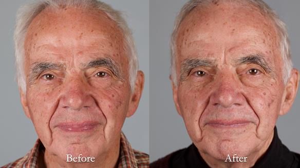 Newsletter 74: Ken’s Case Study Complete Dentures - Life Like and Age Appropriate