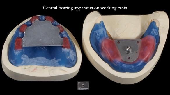 Newsletter 70 Complete Denture Treatment for Kate: A Case Study on Natural-Looking Dentures and Implant-Supported Overdentures