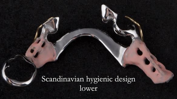 Eileen's transformation with upper and lower RPDs of Scandinavian hygienic design FULL PROTOCOL