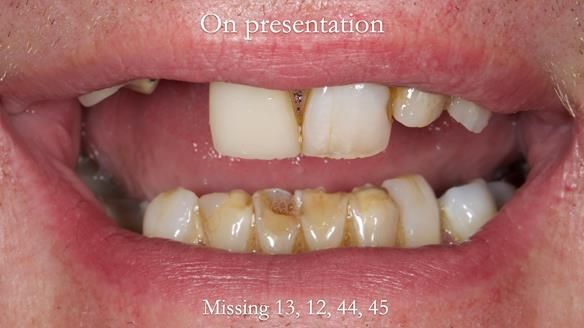 Read Newsletter 67 - Brian's COMBAT DENTURE Case Study