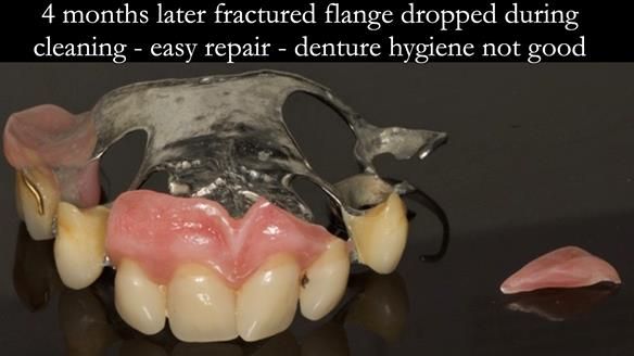 Newsletter 71 Jean’s Class I Mod III RPD: See my mistakes Fractured Mk1 to a Stronger Mk2 RPD (4 years on)